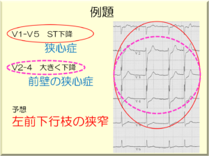 12誘導心電図と左心室壁との関係